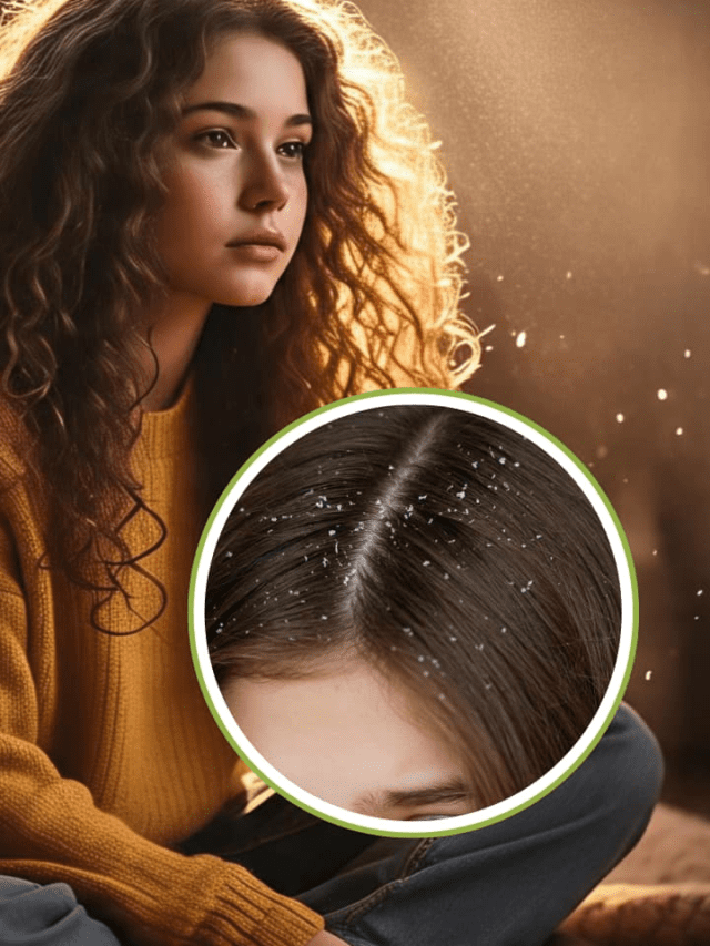 7 Game-Changing Tips To Tackle Dandruff Fast
